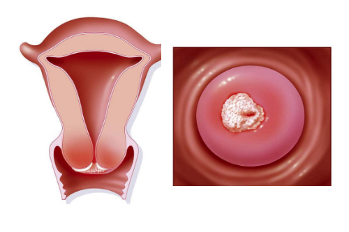 宫颈糜烂对身体有什么影响 宫颈糜烂对身体有什么影响