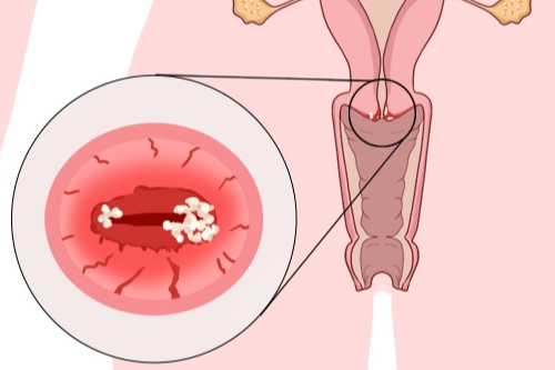 宫颈糜烂的原因有哪些 宫颈糜烂的原因有哪些