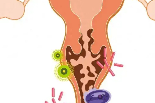 阴部潮湿瘙痒是什么原因 阴部潮湿瘙痒是什么原因